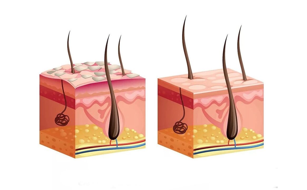 Δέρμα με ψωρίαση πριν και μετά την εφαρμογή της κρέμας
