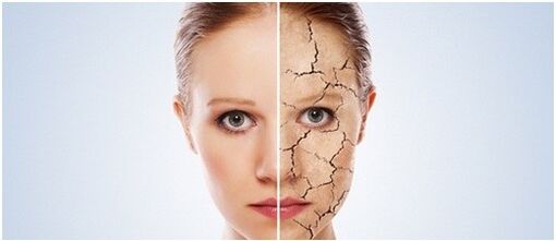 Αντιμετωπίζουμε την ψωρίαση