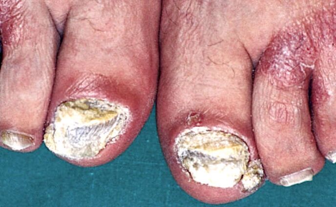Σοβαρή υπογλώσσια υπερκεράτωση και ψωριασικές πλάκες στα δάχτυλα των ποδιών