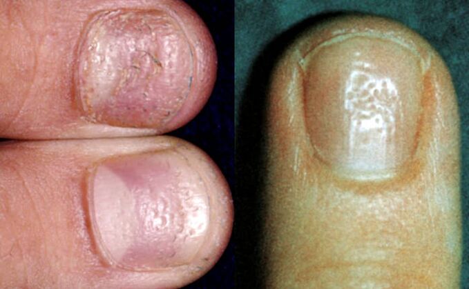 Σύμπτωμα δακτυλήθρα - πολλαπλές καταθλίψεις στην επιφάνεια της πλάκας των νυχιών