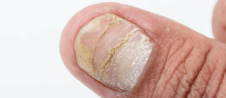 οξεία μορφή επιπλοκών της ψωρίασης στα νύχια